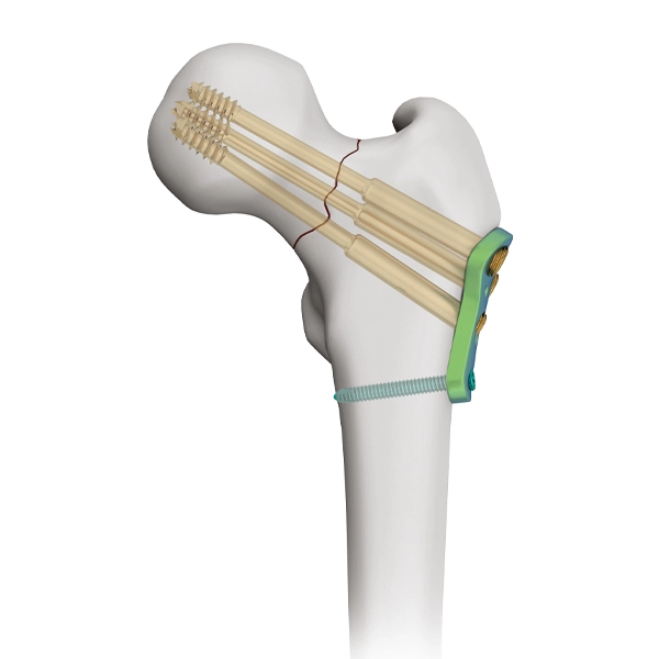 Placa de bloqueo femoral proximal para tornillo canulado de 7,3 mm