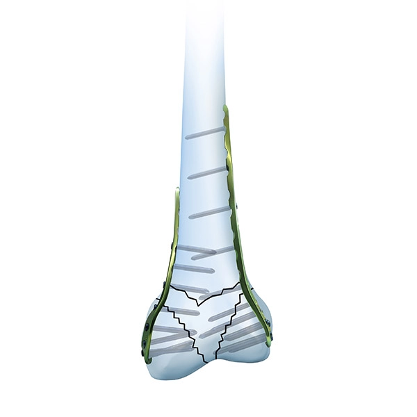 Sistema de placa de bloqueo femoral distal C3