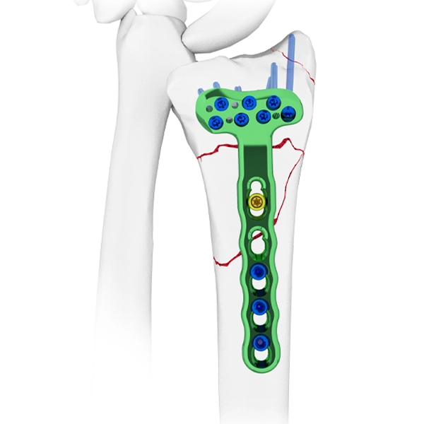 Placa de bloqueo radial volar distal, con guía de broca