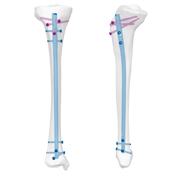 Clavo tibial universal UTN II